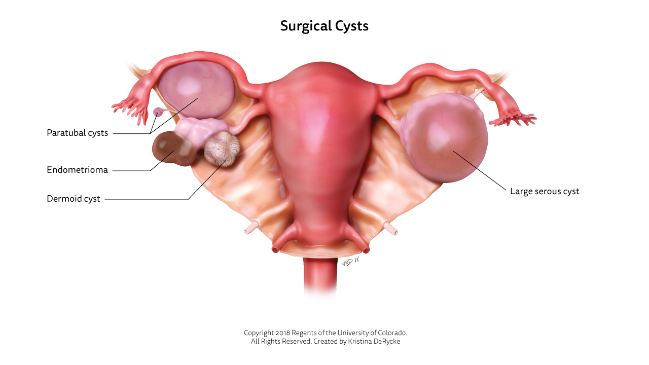 surgical-cysts.jpg.jpg