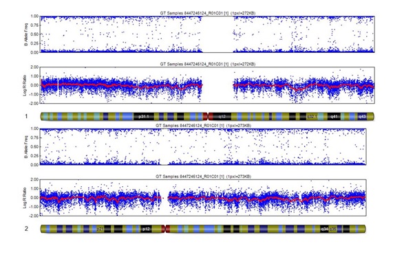 SNP array 技术有效预防葡萄胎