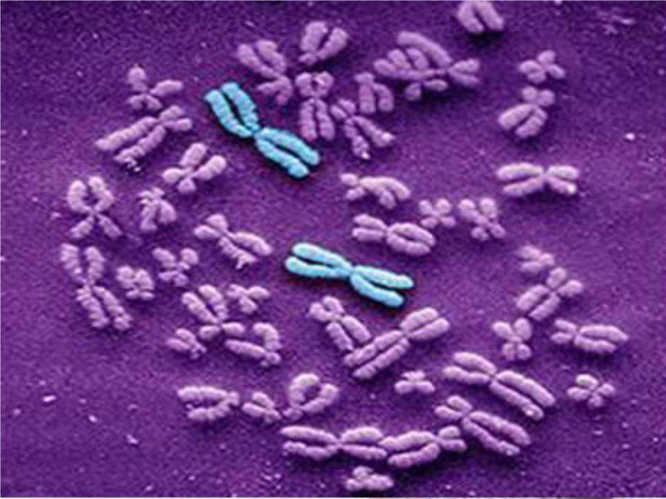 常见染色体异常遗传病 WAGR综合症