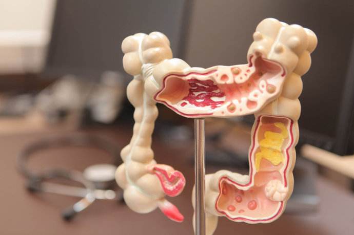 部分结肠癌患者携带遗传基因