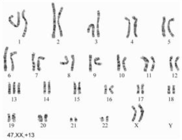 染色体异常遗传病 Patau综合症