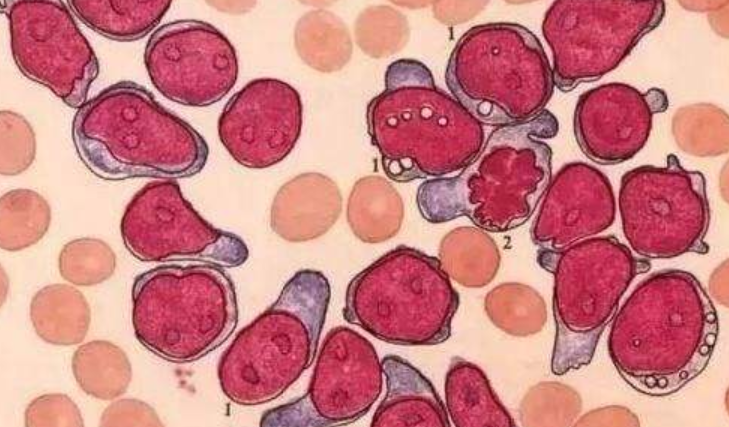 染色体异常遗传病 8p11骨髓增生异常综合症