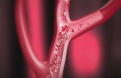 低铁水平可能会增加静脉血栓风险