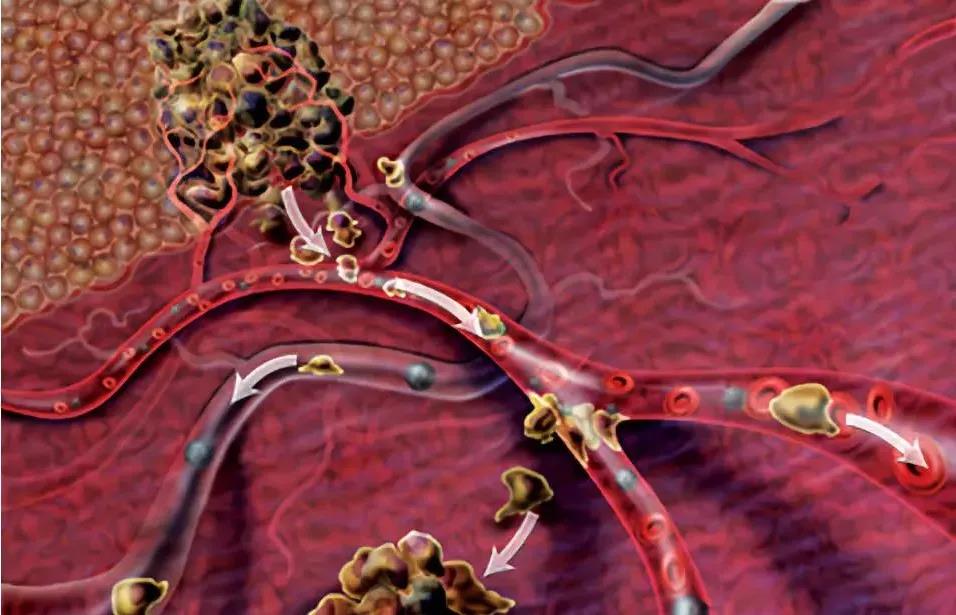 癌症过了三年复发率就低了，过了五年几乎就不会复发了，是这样吗？