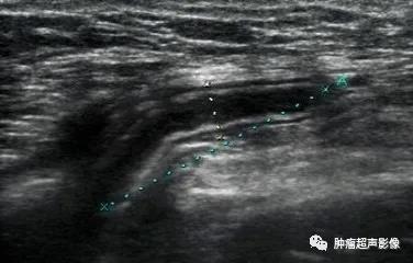 一个需要高度警惕的疝-腹股沟滑动性疝的超声表现