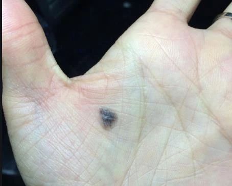 打嗝儿的 病根儿 竟是肝癌