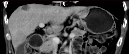 重度营养不良晚期胃癌治疗病例分享