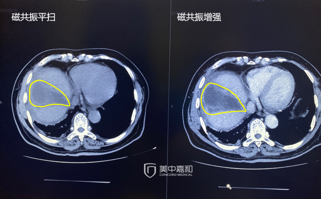 肿瘤破了，容易复发？是真的！