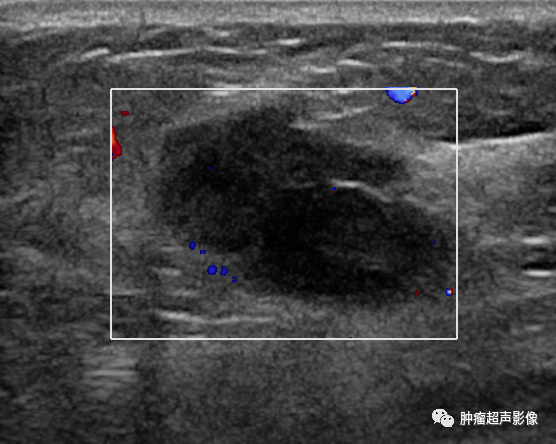 一个病理和超声皆易误诊的肿瘤-乳腺腺肌上皮瘤的超声表现