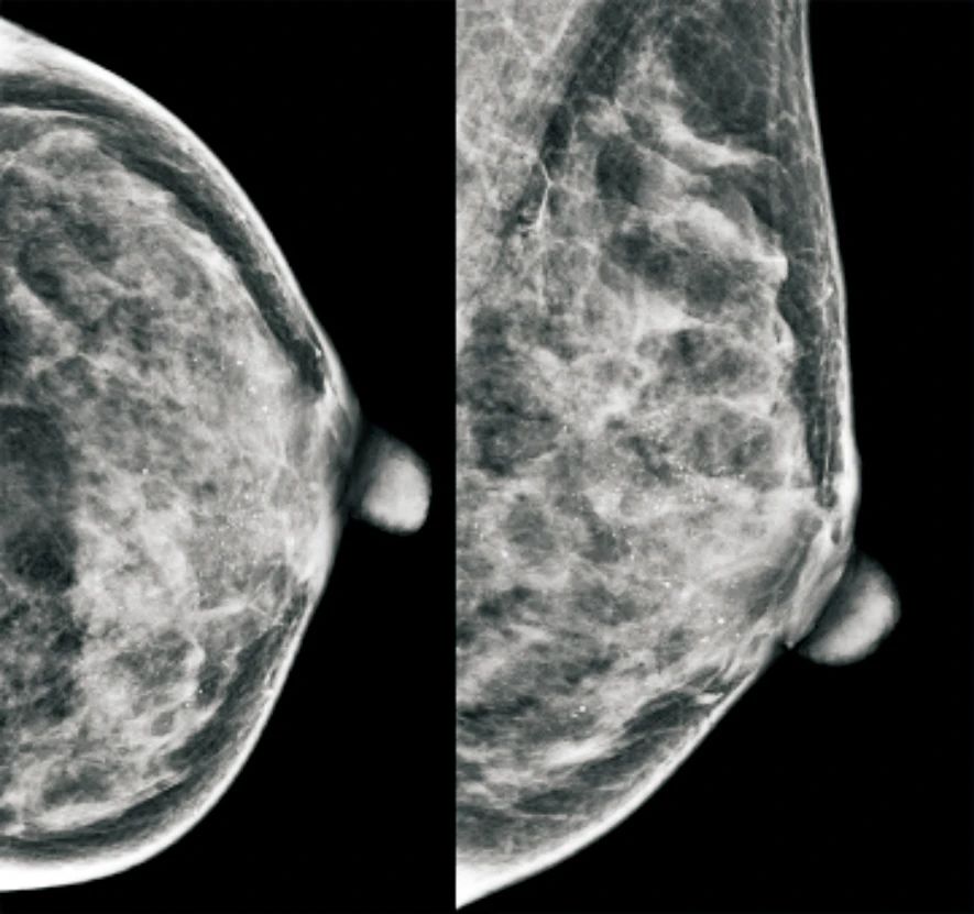 乳腺X线摄影影像学特征与21基因检测复发风险评分的相关性影像基因组学研究