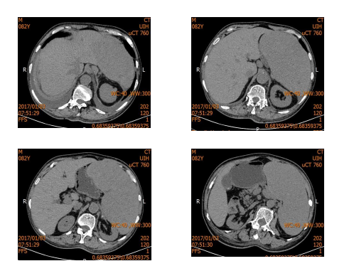 骨髓纤维化伴脾脏肿大早期干预是关键