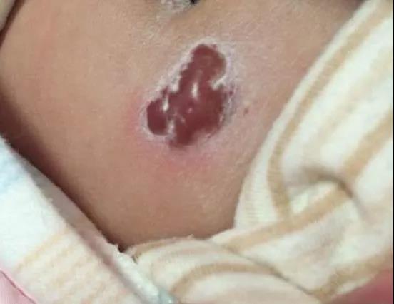 药膏一抹，就能消除血管瘤了吗，别再随意听信网络建议了