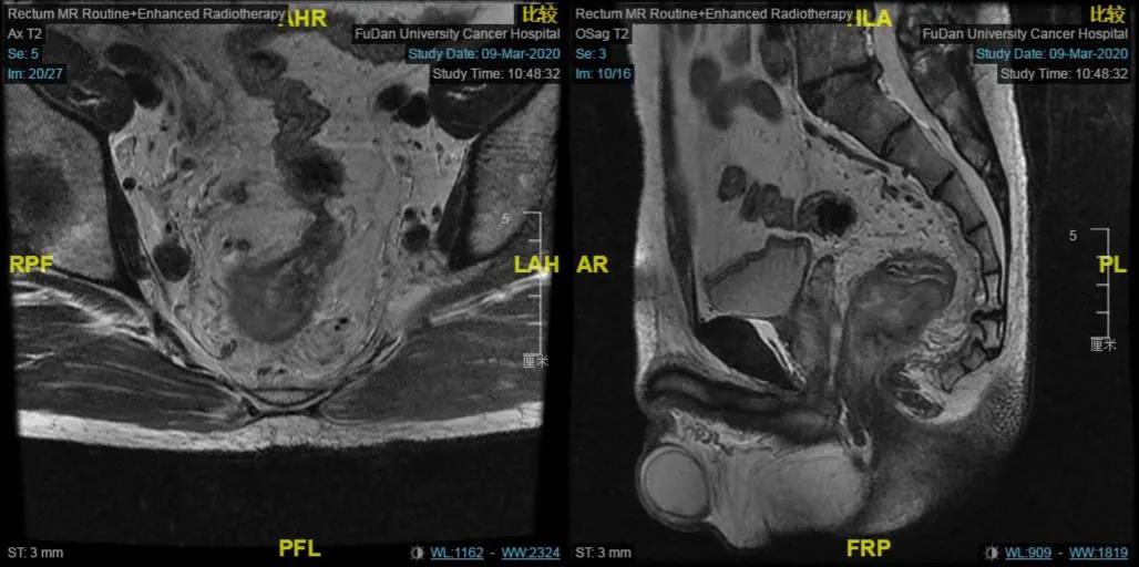 直肠癌患者要保肛到底“难”在哪？李心翔教授为您详解