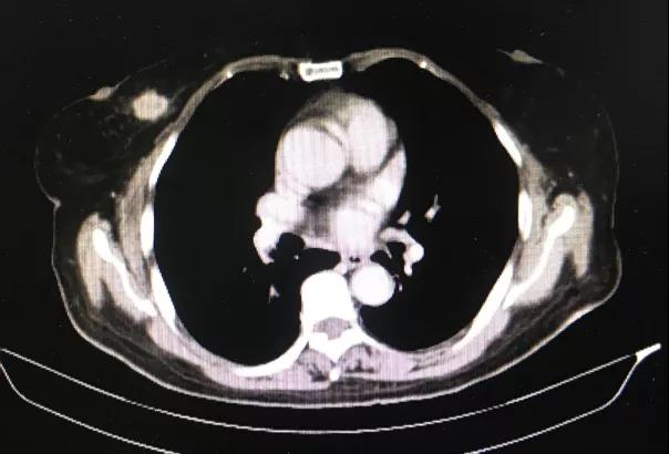 有诺有节——HR+晚期乳腺癌，口服节拍化疗为患者带来生存获益