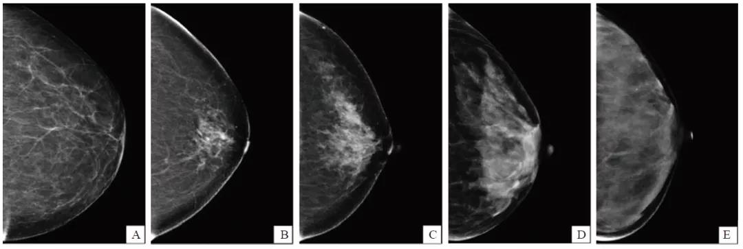 基于第5版乳腺影像报告和数据系统方法评价乳腺密度的一致性研究