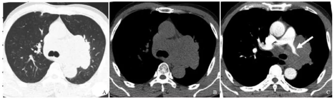 增强CT及双时相PET/CT对肺原发性小细胞神经内分泌癌的诊断价值