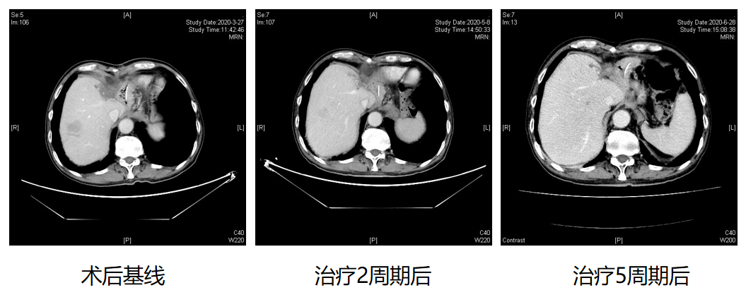 重度营养不良双原发癌患者病例分享