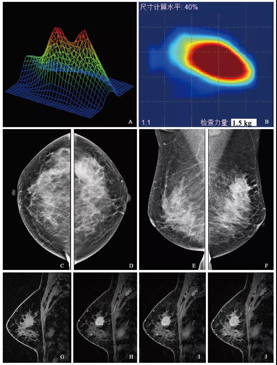 乳腺触诊成像系统对乳腺病变诊断价值的初步研究