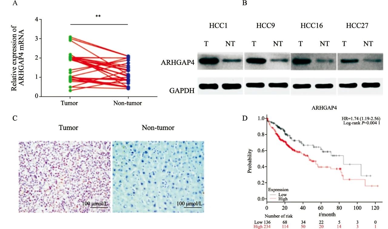  ARHGAP4通过调控HK2表达促进肝癌细胞生长的研究