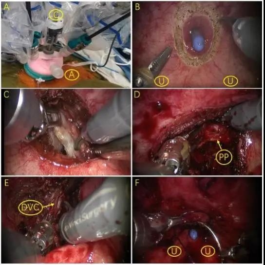 郭剑明教授团队改良机器人辅助腹腔镜前列腺癌根治术荣登EAU，患者获益良多