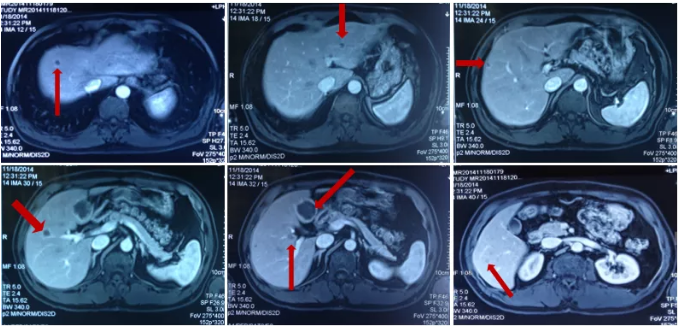 肠癌案例  KRAS基因突变型乙状结肠腺癌伴多次复发转移病例分享