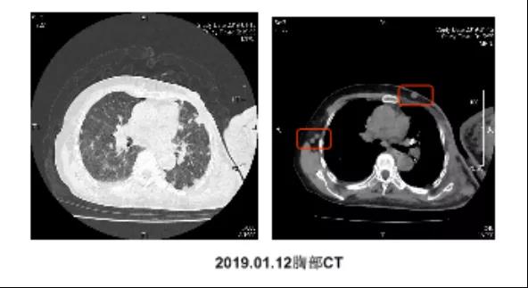 难治性晚期乳腺癌病历分享