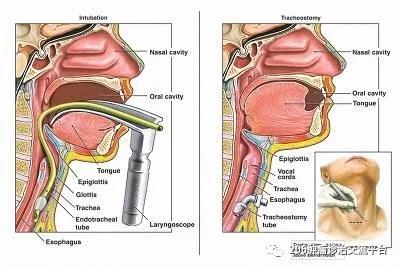 漫谈食管癌 发病 诊断和治疗