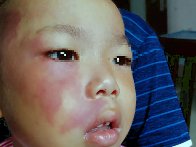 眼部常发的这几种血管瘤 