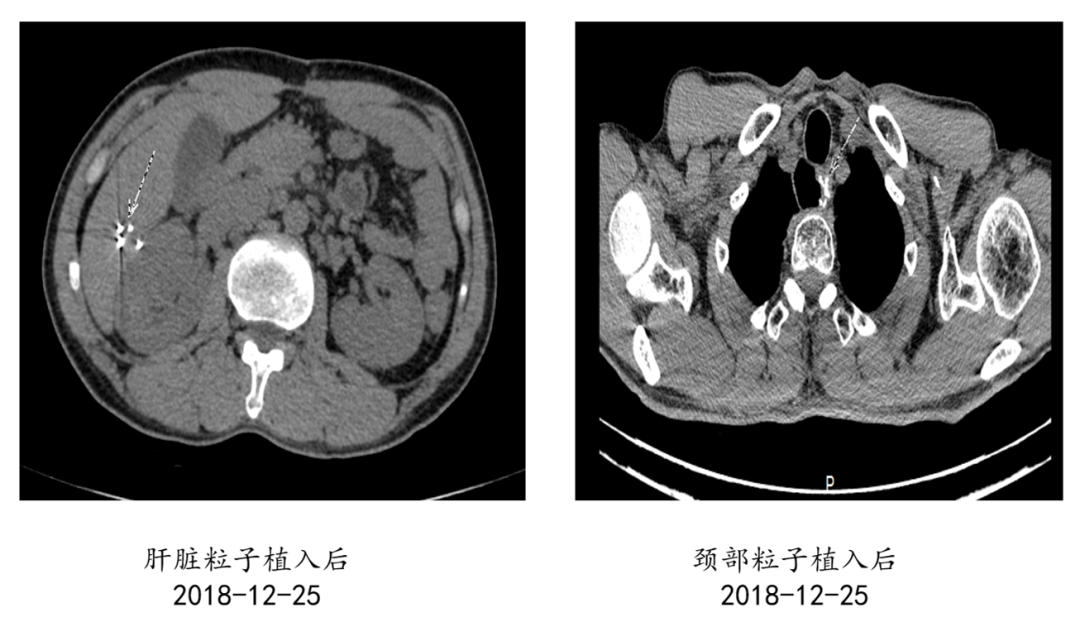抗癌五年, 打不垮击不倒! 坚韧意志让他的抗癌道路“守得免疫见月明”