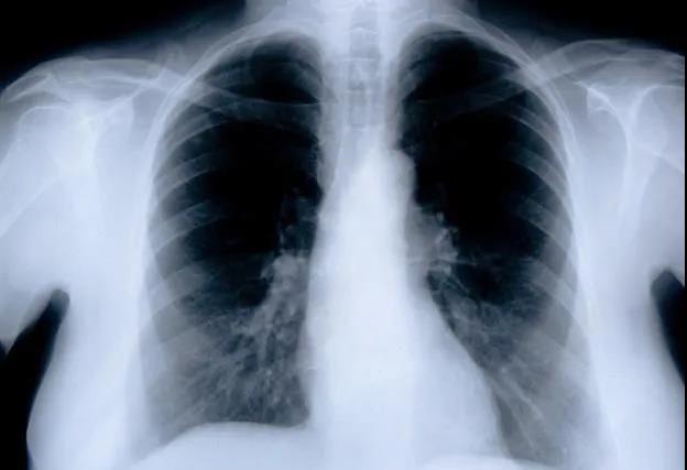 癌症转移到骨头自己发生骨折居然没感觉，如何才能发现癌症骨转移！