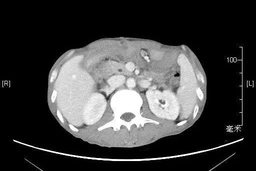 内科诊治癌性肠梗阻病例分享