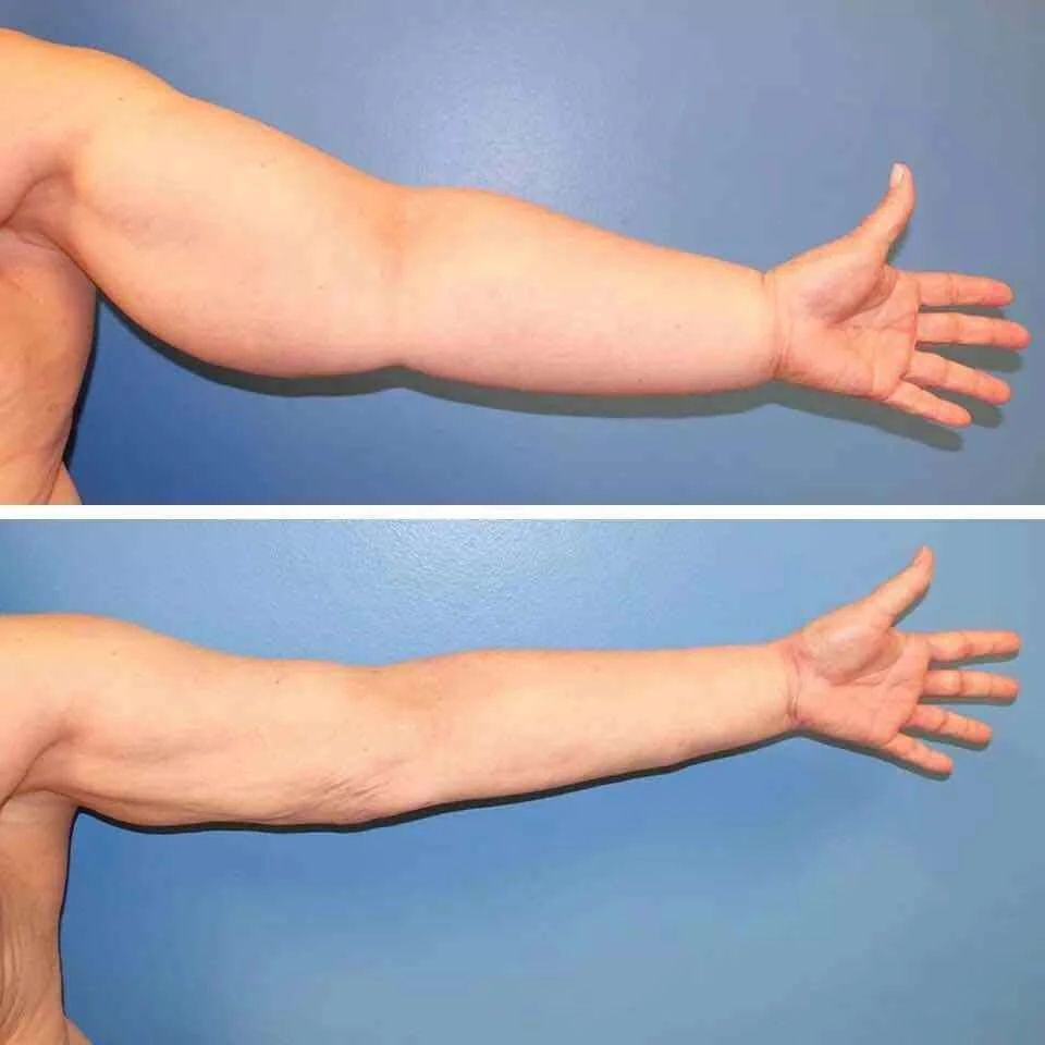 肿瘤医院开设淋巴水肿护理专科门诊啦