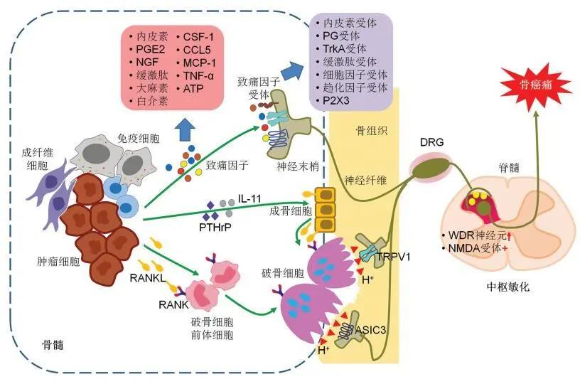 转移性癌性骨痛的分子机制及临床治疗研究进展