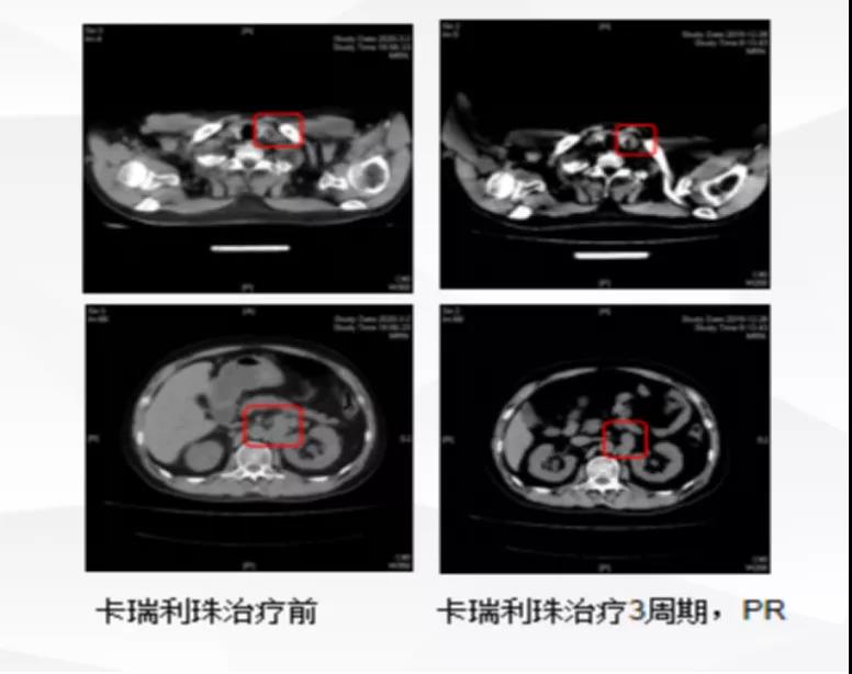 侵蚀性膀胱癌多线化疗病例