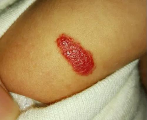 宝宝血管瘤开始消退，家长该注意什么？