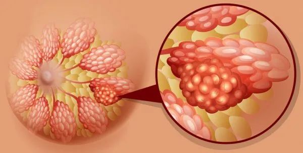 查出乳腺增生怎么办