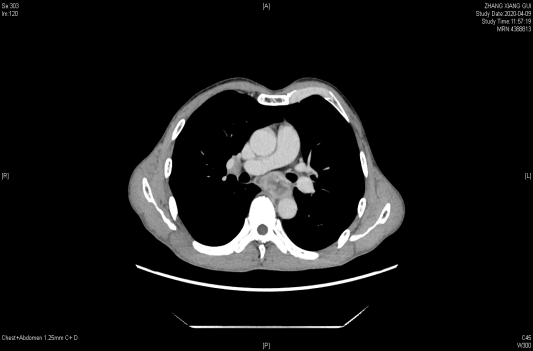 PD-1单抗+化疗新辅助治疗2周期后PR，治疗路上领先一步！