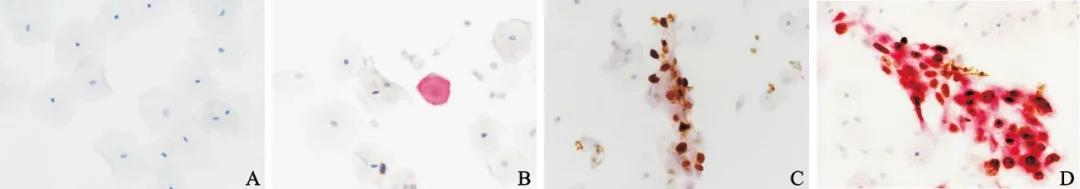 免疫细胞化学p16/Ki-67双染检测对宫颈细胞学阴性且HR-HPV阳性病例的分流作用及组织学LSIL的转归预测价值