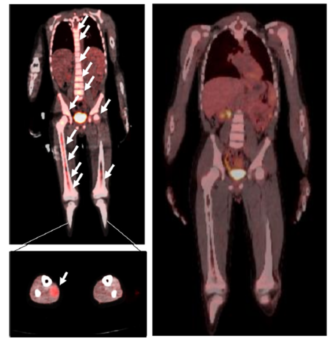 儿童晚期横纹肌肉瘤迎来新希望：HER2靶向CAR-T治疗
