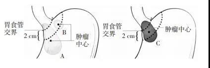 食管-胃结合部腺癌手术治疗的共识与争议