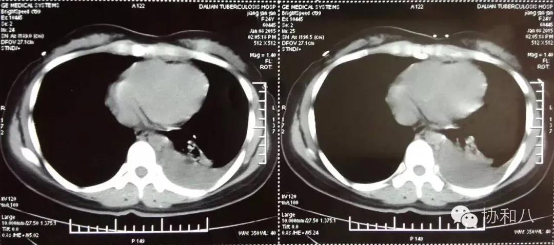 低热、乏力、胸痛，你以为是结核？其实是肿瘤惹的祸！