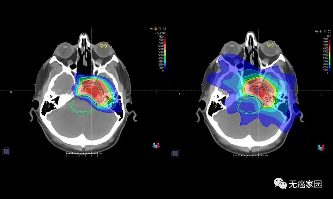 放疗界的“定向导弹”，精准爆破病灶，脑瘤、脊髓瘤一个也不留！