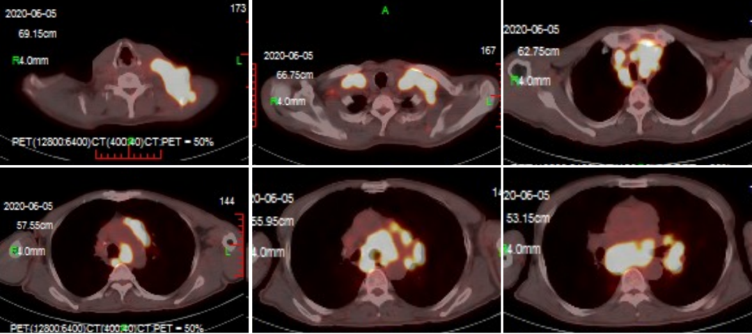 特殊Fc段改造PD-1单抗肺鳞癌显奇效