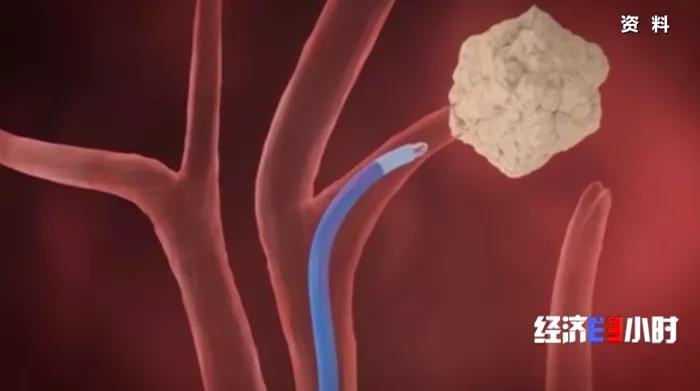 微创治肺癌？胸外科手术不开胸，切口能小十倍！