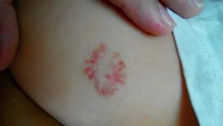 那些“可以再等一等”的血管瘤患儿，后来都怎么样了？