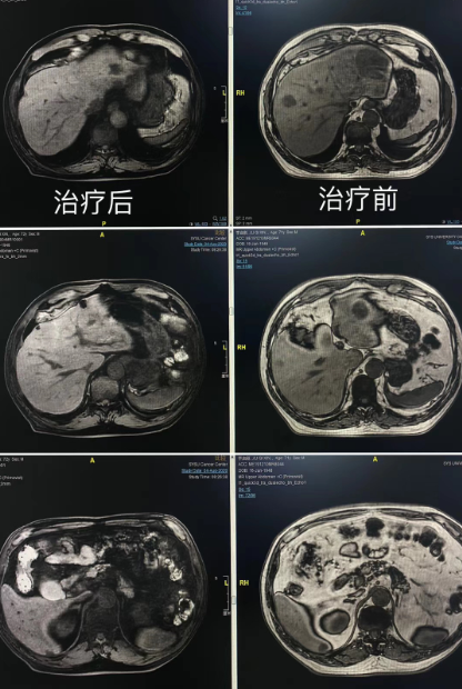 TMB-H 转移性结直肠癌肝转移患者经免疫+手术治疗  达到R0切除