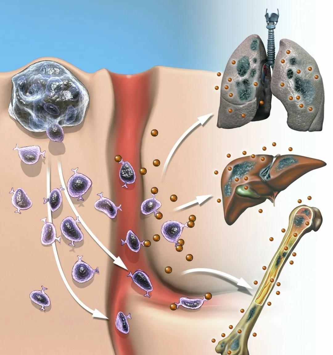 恶性肿瘤扩散转移会有什么症状  需要什么样的诊断手段？