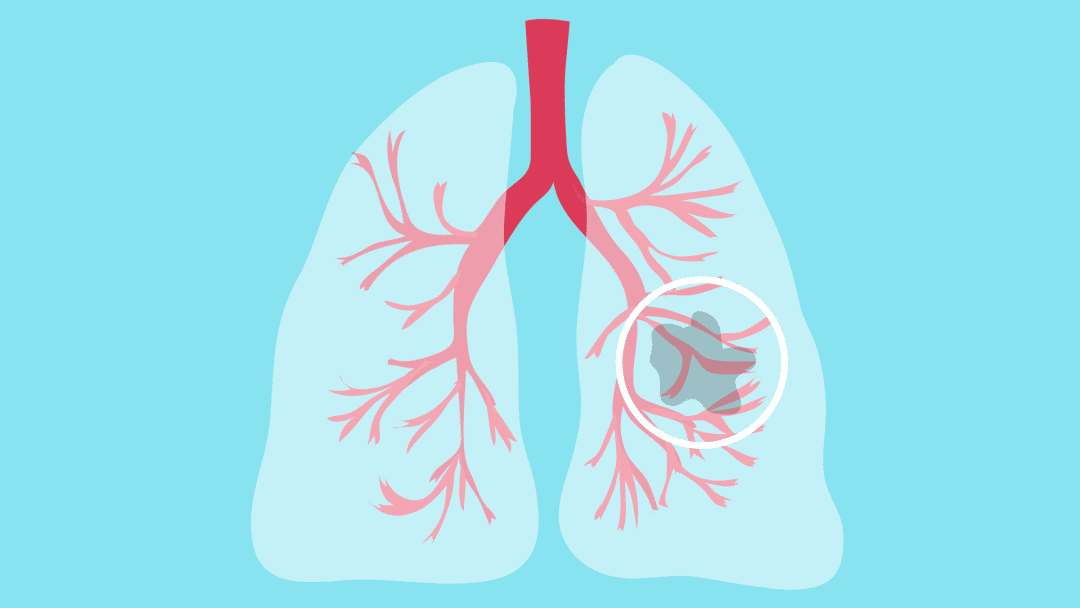 肺癌：抗肿瘤药物处方审核专家共识