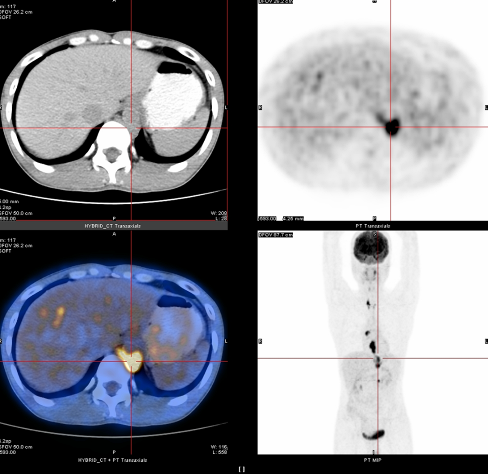 PD-1单抗携手化疗新辅助治疗2周期达PR，食管癌患者重获生机！