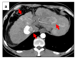 肝癌肝移植术后2次转移  3次复发  还能活12年